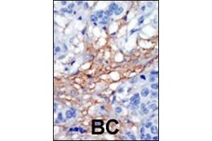 Formalin-fixed and paraffin-embedded human cancer tissue reacted with the primary antibody, which was peroxidase-conjugated to the secondary antibody, followed by AEC staining. (PIP5K1C antibody  (C-Term))