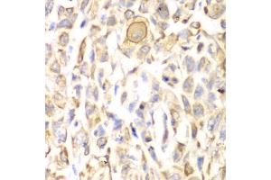Immunohistochemistry of paraffin-embedded human lung cancer using CD151 antibody.