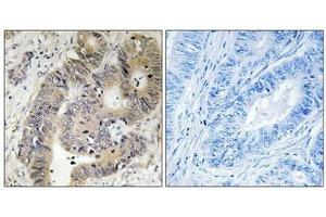 Immunohistochemical analysis of paraffin-embedded human colon carcinoma tissue using CAD (Phospho-Thr456) antibody (left)or the same antibody preincubated with blocking peptide (right). (CAD antibody  (pThr456))