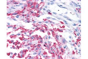 Anti-GRM2 / MGLUR2 antibody IHC of human Skin, Melanoma. (GRM2 antibody  (N-Term))
