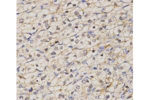 Immunohistochemistry of paraffin-embedded Human kidney cancer using GJC2 Polyclonal Antibody at dilution of 1:200 (40x lens). (GJC2 antibody)