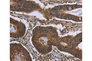 Immunohistochemistry of Human cervical cancer using FHIT Polyclonal Antibody at dilution of 1:30 (FHIT antibody)
