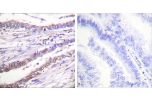 Peptide - +Immunohistochemical analysis of paraffin-embedded human lung carcinoma tissue using Cyclin A antibody (#C0165). (Cyclin A antibody)