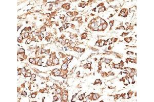 Immunohistochemistry of paraffin-embedded Human mammary cancer using KIR3DS1 Polyclonal Antibody at dilution of 1:100 (40x lens). (KIR3DS1 antibody)