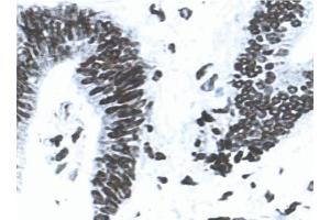 Acetone-fixed, frozen tissue section of human colon carcinoma stained for MLH1 (clone G168-15) using a DAB chromogen and Hematoxylin counterstain. (MLH1 antibody)