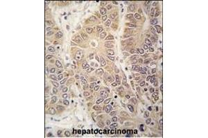 Formalin-fixed and paraffin-embedded human hepatocarcinoma tissue reacted with HARS antibody (N-term) (ABIN391819 and ABIN2841666) , which was peroxidase-conjugated to the secondary antibody, followed by DAB staining. (HARS1/Jo-1 antibody  (N-Term))