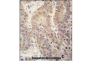 Formalin-fixed and paraffin-embedded human hepatocarcinoma tissue reacted with HARS antibody (N-term) (ABIN391819 and ABIN2841666) , which was peroxidase-conjugated to the secondary antibody, followed by DAB staining.