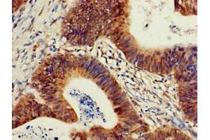 Immunohistochemistry of paraffin-embedded human colon cancer using ABIN7163167 at dilution of 1:100
