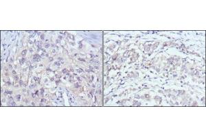 Immunohistochemical analysis of paraffin-embedded human lung cancer (left) and gastric cancer (right) using PAK2 antibody with DAB staining. (PAK2 antibody)
