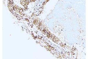 ABIN6275439 at 1/100 staining Human lung cancer tissue by IHC-P. (RSAD1 antibody  (Internal Region))