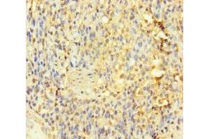 Immunohistochemistry of paraffin-embedded human gastric cancer using ABIN7156759 at dilution of 1:100 (IL1RL2 antibody  (AA 20-218))