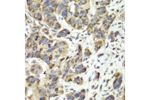 Immunohistochemistry of paraffin-embedded human esophageal cancer using SLC25A4 antibody at dilution of 1:100 (400x lens). (SLC25A4 antibody)