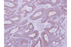 IHC-P Image Immunohistochemical analysis of paraffin-embedded human colon carcinoma, using PKA 2 beta, antibody at 1:500 dilution. (PKA 2 beta (Center) antibody)