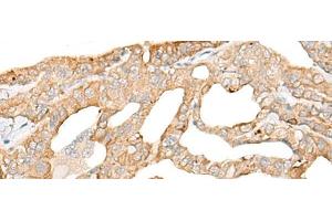 Immunohistochemistry of paraffin-embedded Human thyroid cancer tissue using DDX24 Polyclonal Antibody at dilution of 1:35(x200) (DDX24 antibody)