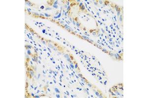 Immunohistochemistry of paraffin-embedded human stomach cancer using CTSG antibody (ABIN5974986) at dilution of 1/100 (40x lens). (Cathepsin G antibody)