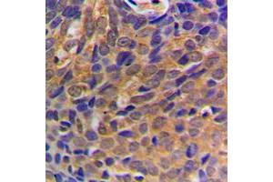Immunohistochemical analysis of Beta-catenin staining in human breast cancer formalin fixed paraffin embedded tissue section. (beta Catenin antibody  (N-Term))
