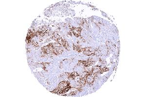 Colorectal adenocarcinoma with strong L1CAM staining of a large fraction of tumor cells