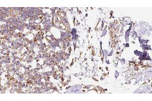 ABIN6276656 at 1/100 staining Human Melanoma tissue by IHC-P. (Ghrelin antibody  (C-Term))