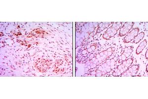 Immunohistochemical analysis of paraffin-embedded colon cancer tissues (left) and human larynx cancer tissues (right) using KDM4A mouse mAb with DAB staining.