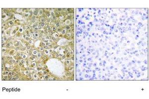 Immunohistochemistry analysis of paraffin-embedded human breast carcinoma tissue using ACVRL1 polyclonal antibody .
