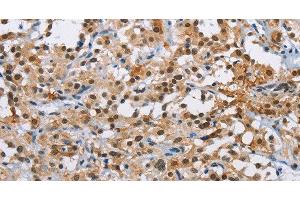 Immunohistochemistry of paraffin-embedded Human thyroid cancer using ATXN1 Polyclonal Antibody at dilution of 1:40 (Ataxin 1 antibody)