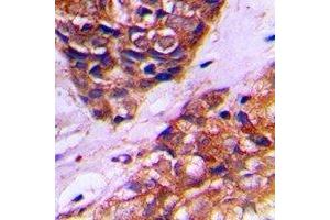 Immunohistochemical analysis of PEX10 staining in human prostate cancer formalin fixed paraffin embedded tissue section. (PEX10 antibody)