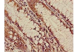 Immunohistochemistry of paraffin-embedded human colon cancer using ABIN7144542 at dilution of 1:100 (ALOX5 antibody  (AA 2-149))