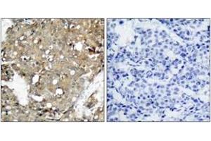 Immunohistochemistry analysis of paraffin-embedded human breast carcinoma tissue, using STAT1 (Ab-727) Antibody. (STAT1 antibody  (AA 694-743))