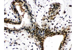 Visfatin was detected in paraffin-embedded sections of human mammary cancer tissues using rabbit anti- Visfatin Antigen Affinity purified polyclonal antibody (Catalog # ) at 1 µg/mL. (NAMPT antibody  (AA 62-337))