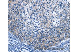 Immunohistochemistry of Human cervical cancer using IL2RB Polyclonal Antibody at dilution of 1:30 (IL2 Receptor beta antibody)
