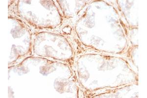 Formalin-fixed, paraffin-embedded human Prostate Carcinoma stained with Galectin-1 Monospecific Recombinant Rabbit Monoclonal Antibody (GAL1/2499R). (Recombinant LGALS1/Galectin 1 antibody  (AA 12-108))