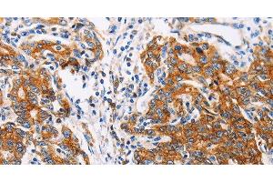 Immunohistochemistry of paraffin-embedded Human gastic cancer using CTNNA1 Polyclonal Antibody at dilution of 1:35 (CTNNA1 antibody)