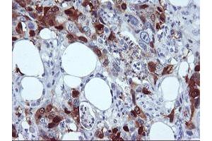 Immunohistochemical staining of paraffin-embedded Carcinoma of Human pancreas tissue using anti-SERPINB2 mouse monoclonal antibody.