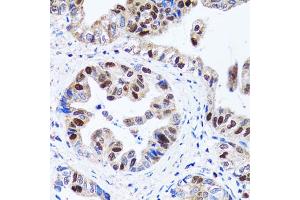 Immunohistochemistry of paraffin-embedded human gastric cancer using UHRF1 antibody.