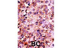 Formalin-fixed and paraffin-embedded human cancer tissue reacted with PANK3 polyclonal antibody  , which was peroxidase-conjugated to the secondary antibody, followed by AEC staining. (PANK3 antibody  (N-Term))