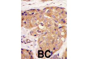 Formalin-fixed and paraffin-embedded human breast carcinoma tissue reacted with SOST polyclonal antibody  , which was peroxidase-conjugated to the secondary antibody, followed by DAB staining. (Sclerostin antibody  (N-Term))