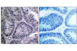 Immunohistochemical analysis of paraffin-embedded human colon carcinoma tissue, using IKKα (Ab-23) antibody (E021123). (IKK alpha antibody)
