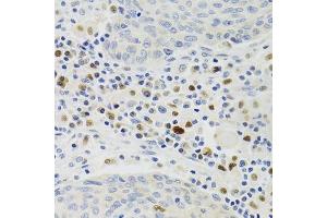 Immunohistochemistry of paraffin-embedded human lung cancer using GEMIN2 Antibody. (SIP1 antibody)
