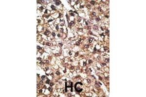 Formalin-fixed and paraffin-embedded human cancer tissue reacted with the primary antibody, which was peroxidase-conjugated to the secondary antibody, followed by AEC staining. (PINK1 antibody  (N-Term))