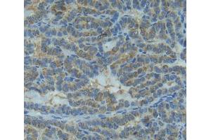 IHC-P analysis of thyroid cancer tissue, with DAB staining.