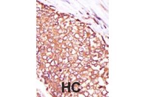 Formalin-fixed and paraffin-embedded human cancer tissue reacted with the primary antibody, which was peroxidase-conjugated to the secondary antibody, followed by DAB staining. (PKC theta antibody  (C-Term))