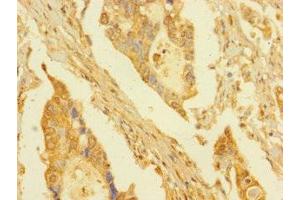 Immunohistochemistry of paraffin-embedded human pancreatic cancer using ABIN7165304 at dilution of 1:100 (DPY30 antibody  (AA 1-99))
