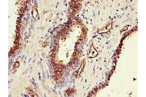 Immunohistochemistry of paraffin-embedded human prostate cancer using ABIN7170330 at dilution of 1:100 (SORD antibody  (AA 201-357))