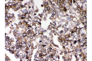 Anti- AIM2 Picoband antibody, IHC(P) IHC(P): Human Lung Cancer Tissue (AIM2 antibody  (AA 14-215))
