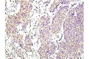 Immunohistochemistry analyzes of CHK1 antibody (pSer317) in paraffin-embedded Human lung adenocarcinoma tissue. (CHEK1 antibody  (pSer317))