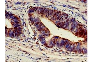 Immunohistochemistry of paraffin-embedded human colon cancer using ABIN7143447 at dilution of 1:100 (ARF4 antibody  (AA 1-180))