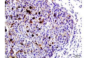 Formalin-fixed and paraffin embedded mouse lung cancer labeled with Anti-LRP1/CD91 Polyclonal Antibody, Unconjugated (ABIN748988) at 1:200 followed by conjugation to the secondary antibody and DAB staining (LRP1 antibody  (AA 4451-4545))