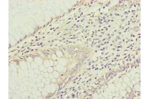 Immunohistochemistry of paraffin-embedded human colon cancer using ABIN7156905 at dilution of 1:100 (IL1F9 antibody  (AA 1-169))