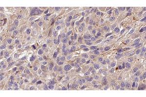 ABIN6272299 at 1/100 staining Human Melanoma tissue by IHC-P. (FGF22 antibody  (Internal Region))