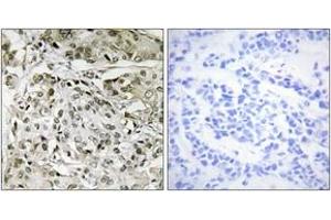 Immunohistochemistry analysis of paraffin-embedded human breast carcinoma tissue, using TAF1 Antibody.